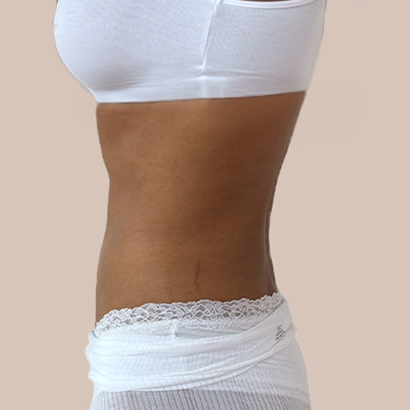 Before stomach AirSculpt