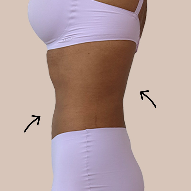 After stomach AirSculpt