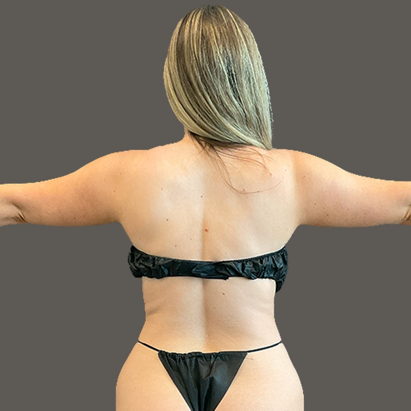 Back of Arms Before AirSculpt