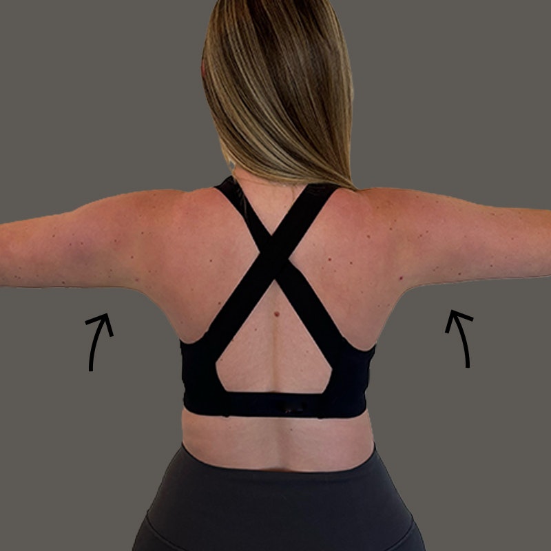 Back of Arms After AirSculpt