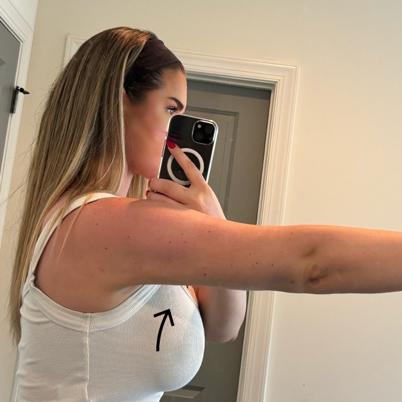 Side of Arms After AirSculpt