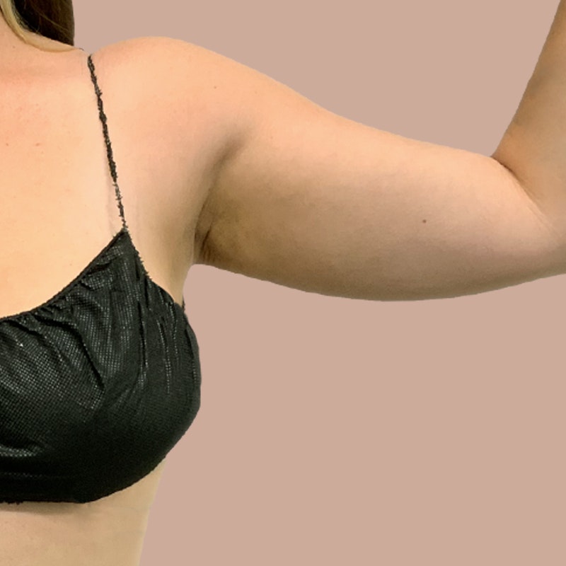 Arms before airsculpt