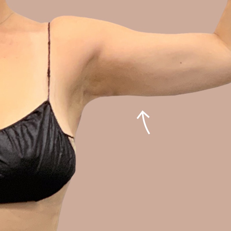 Arms after AirSculpt