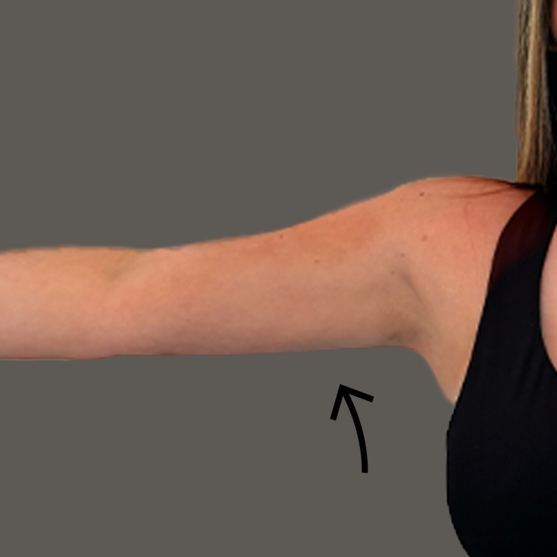 Savannah Brymer Front Arms After AirSculpt