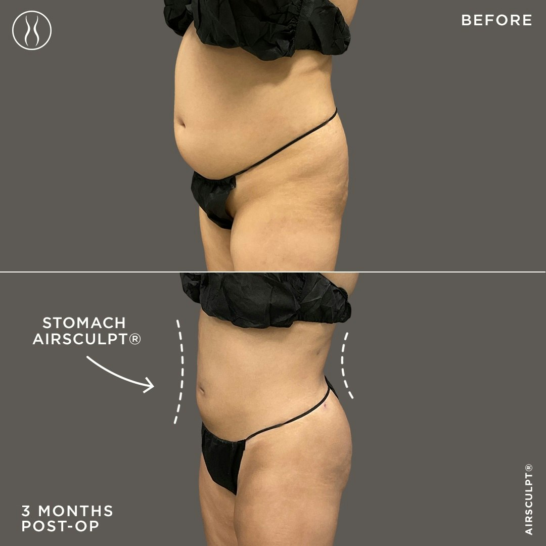 before and after stomach airsculpt - scar example