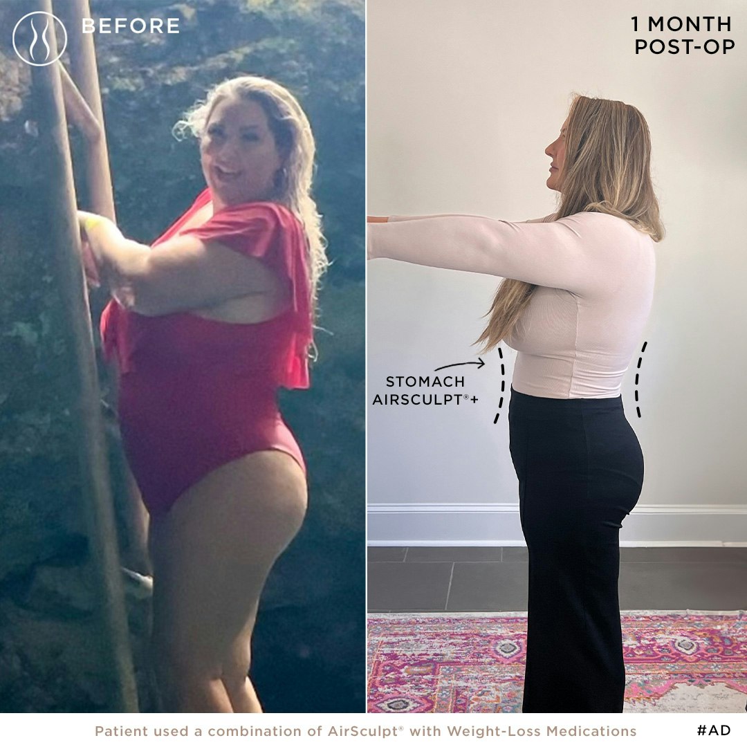 Ady Meschke before and after AirSculpt+ and GLP-1 meds