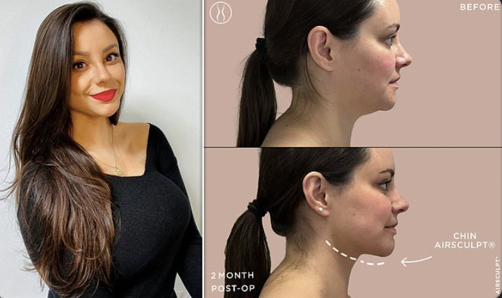 Emma North profile and chin airsculpt before and after photo