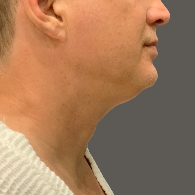 chin before airsculpt