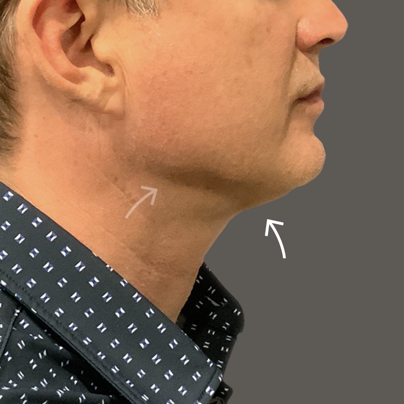 Chin after airsculpt