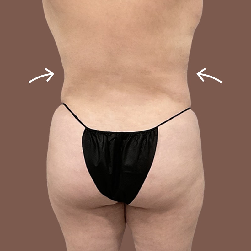 Back after airsculpt