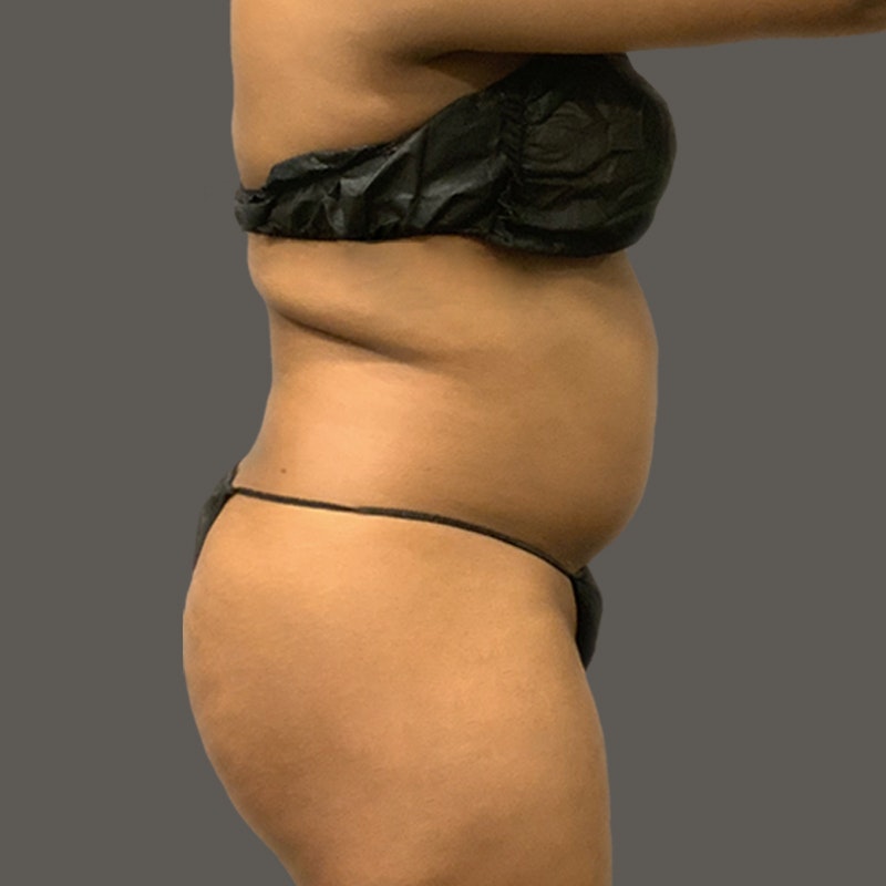 Stomach before AirSculpt
