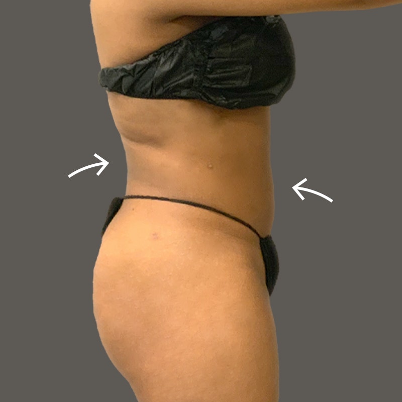Stomach After AirSculpt