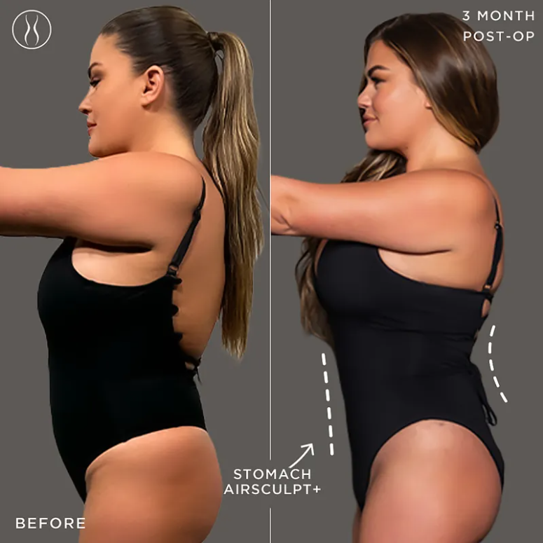 Brittany Cartwright before and after airsculpt side view