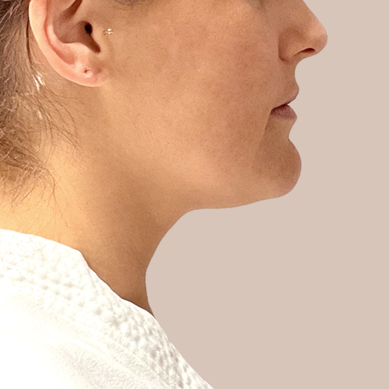 chin before airsculpt