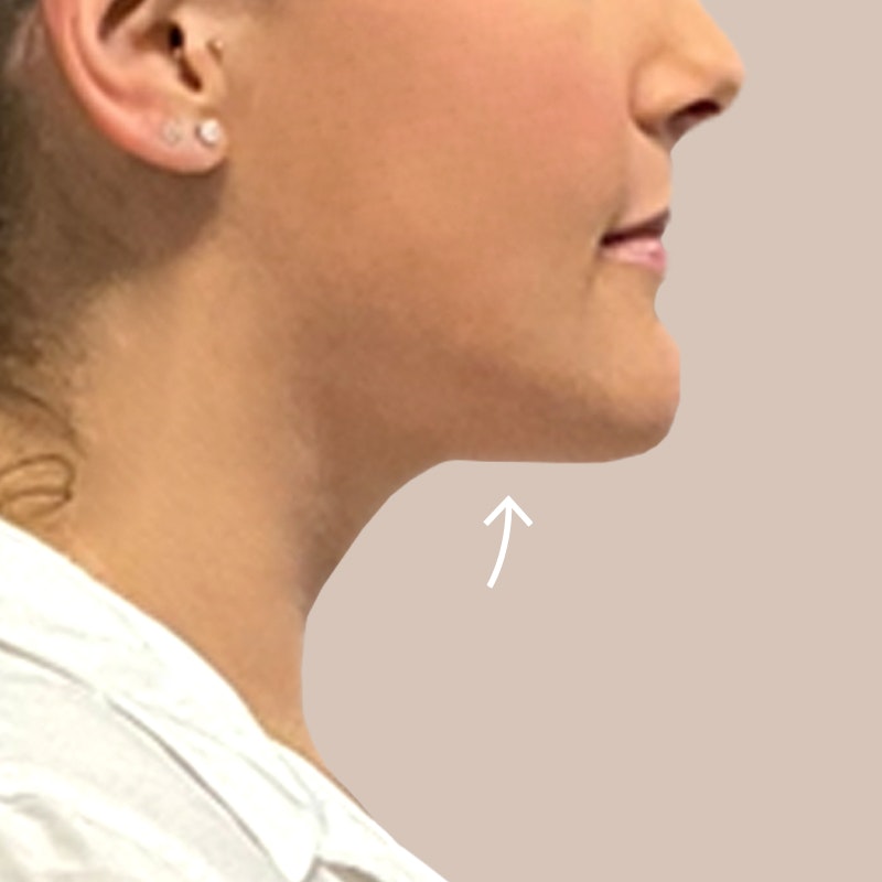 Chin after airscult