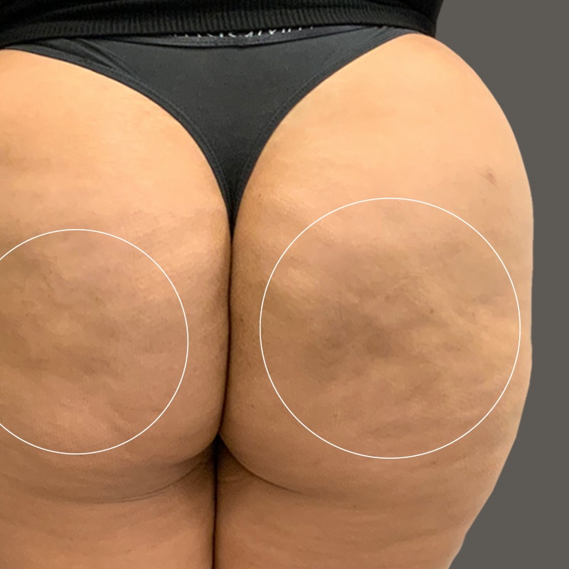 butt after smooth
