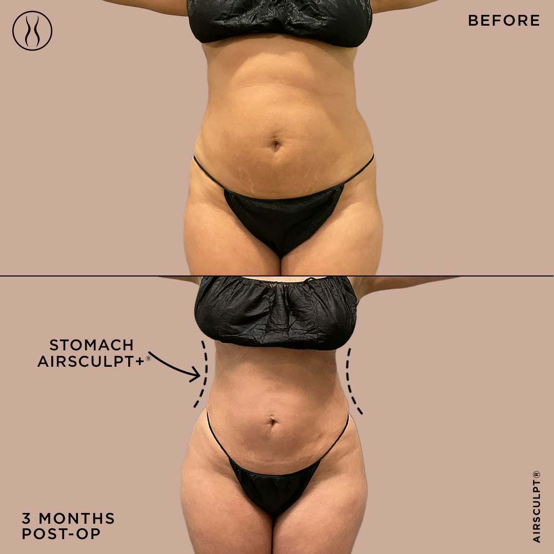 Renuvion skin tightening before and after - front view of abdomen