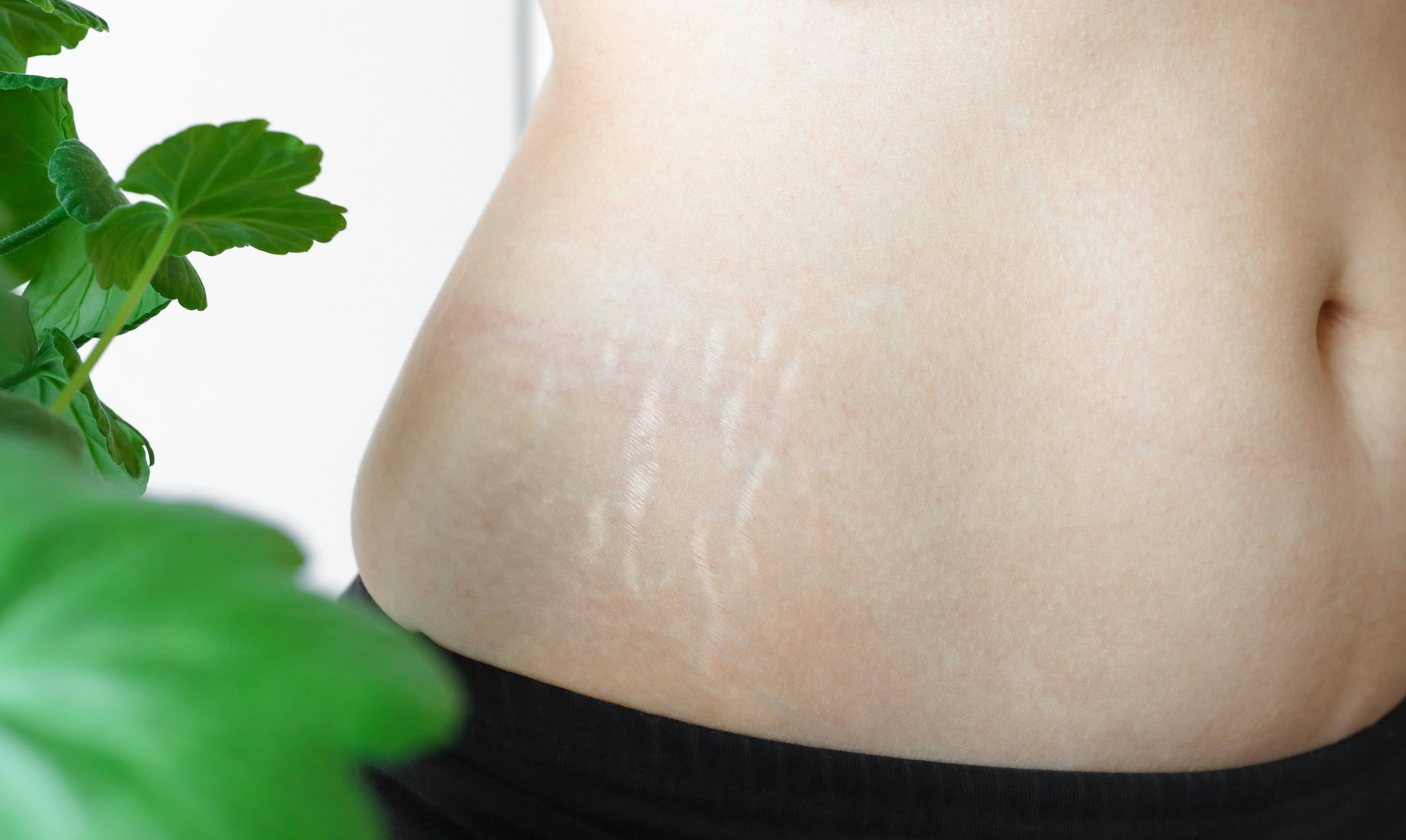 Dealing With Uneven Results After Stomach Liposuction? AirSculpt Can Fix That!