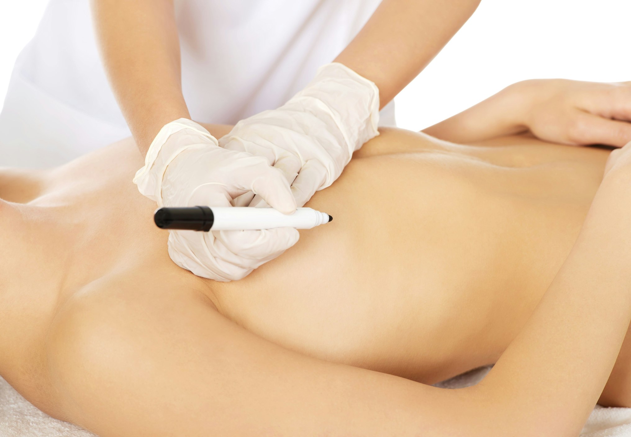 Tips and Alternatives for Minimizing Breast Implant Scars