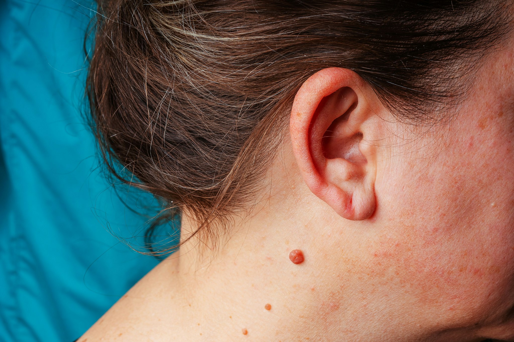 Buffalo Hump Removal: San Diego's Best Neck Fat Procedure