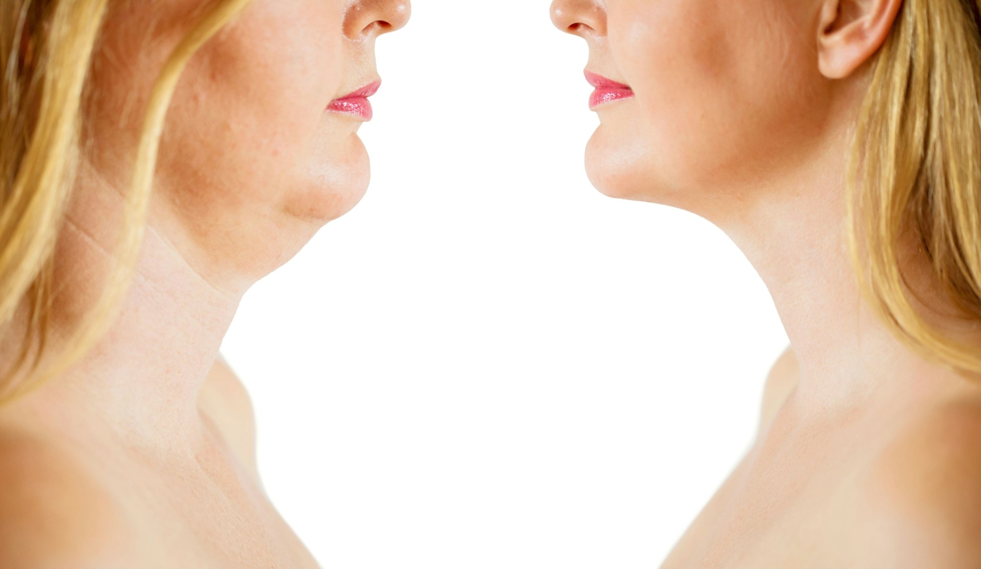 woman's chin before and after lipo