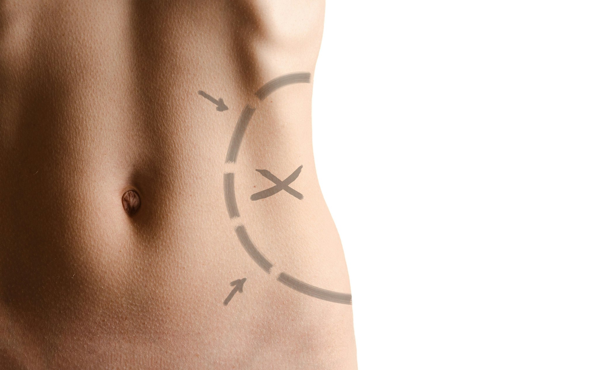lines on abdomen