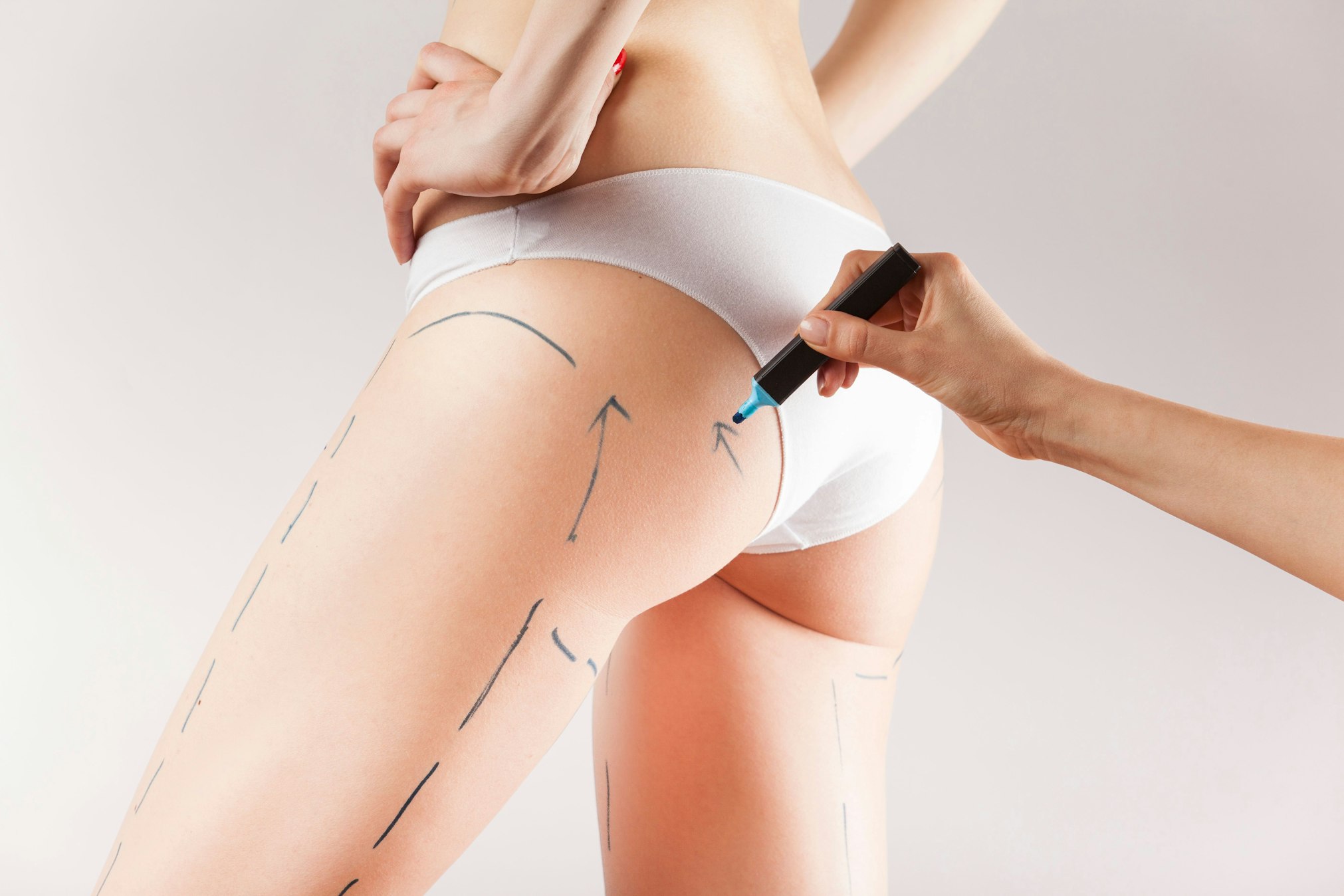 tracing thigh and buttocks for cosmetic changes