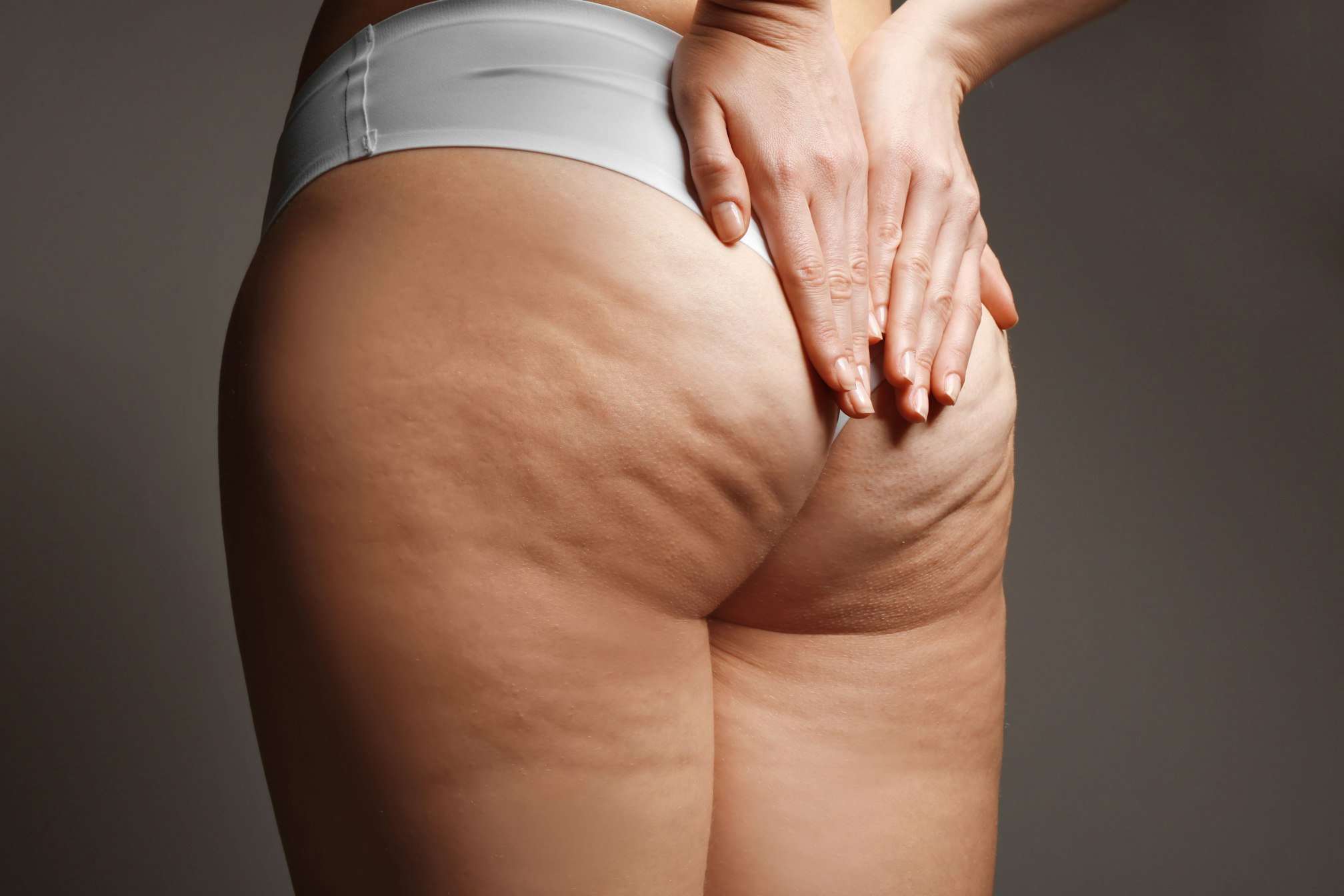 Aveli and Cellulite Everything You Should Know About This Innovative Treatment