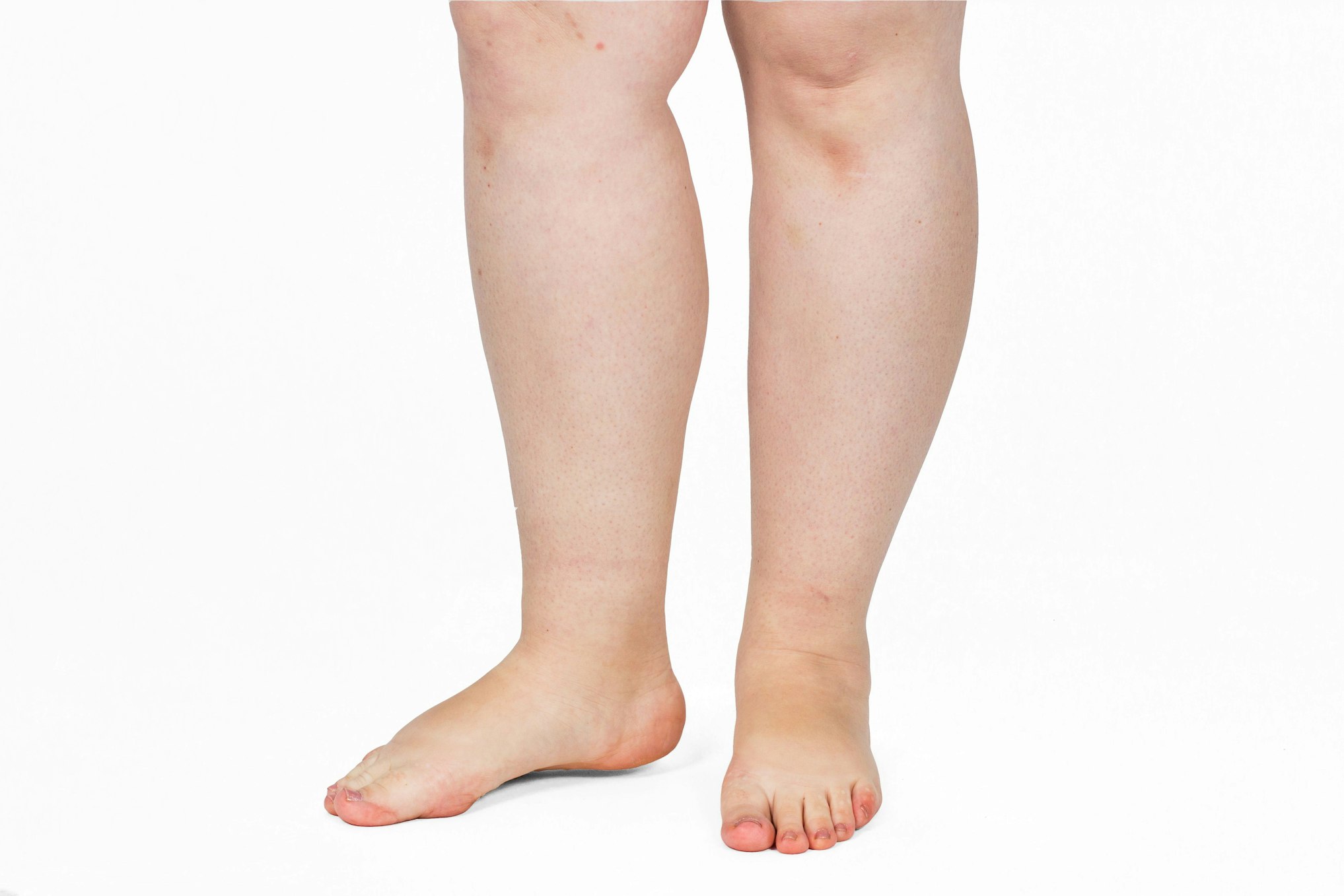 legs with cankles
