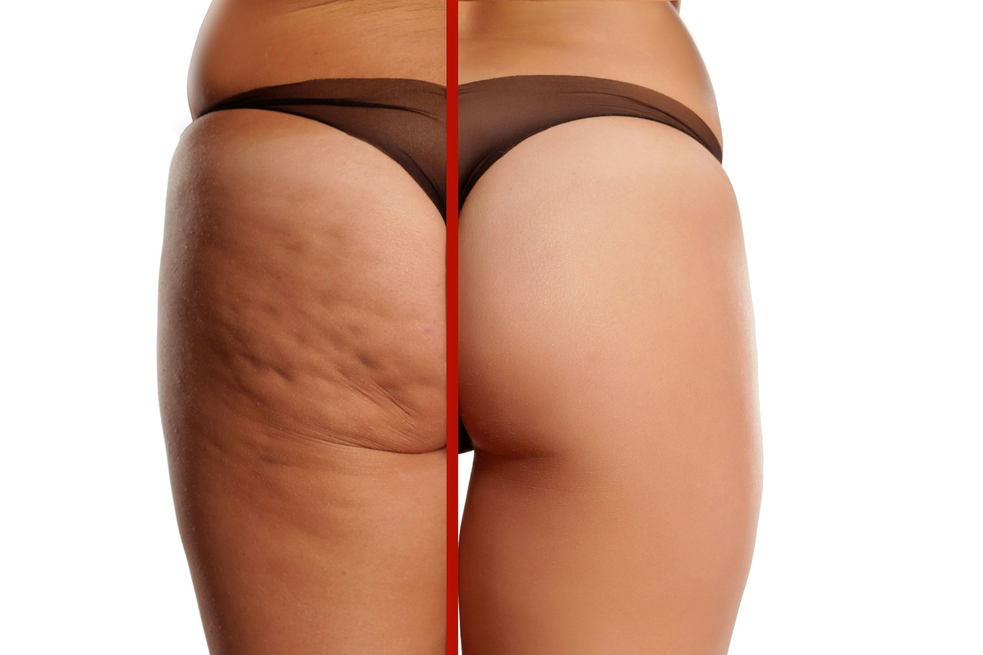 thumbnail image of cellulite removal before and after results