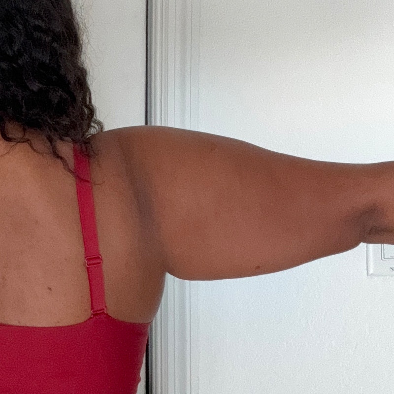 Zoe Arm Before