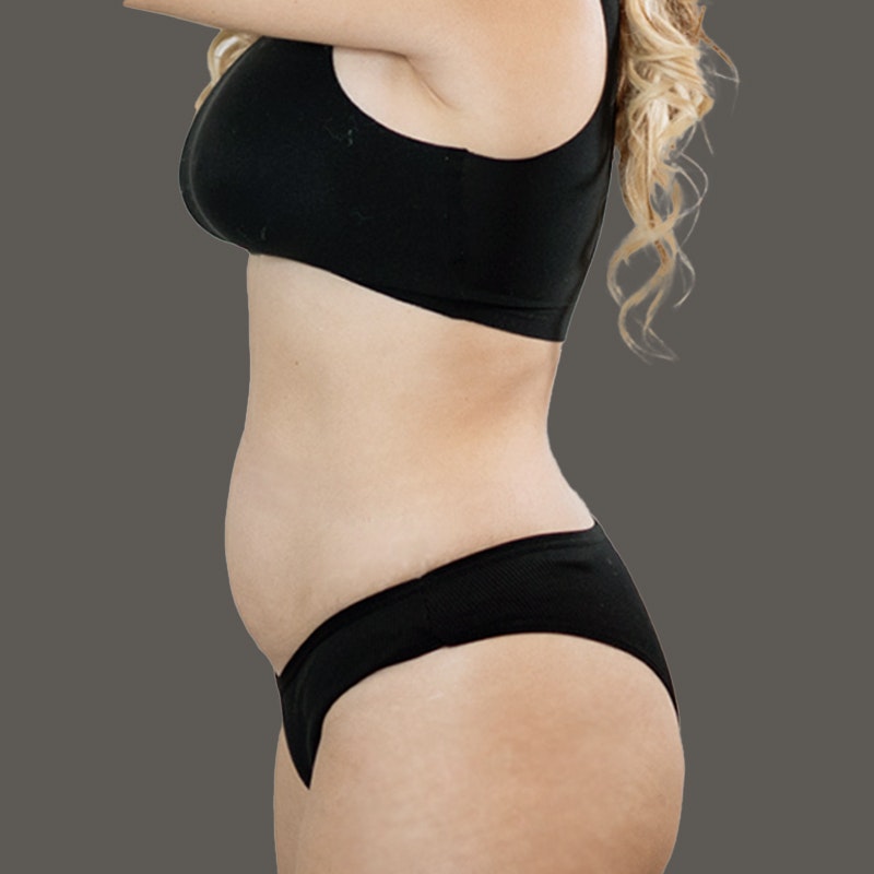 Michelle Posada Before AirSculpt