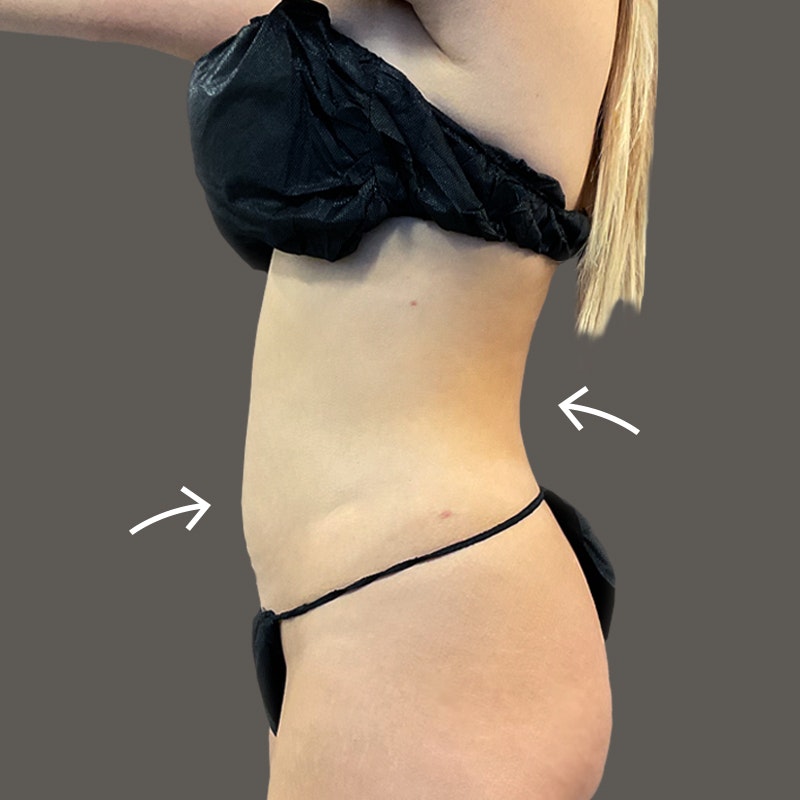 Michelle Posada After AirSculpt