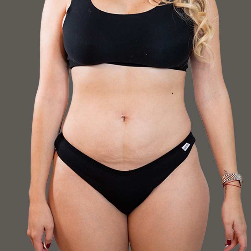 Michelle Posada Before AirSculpt