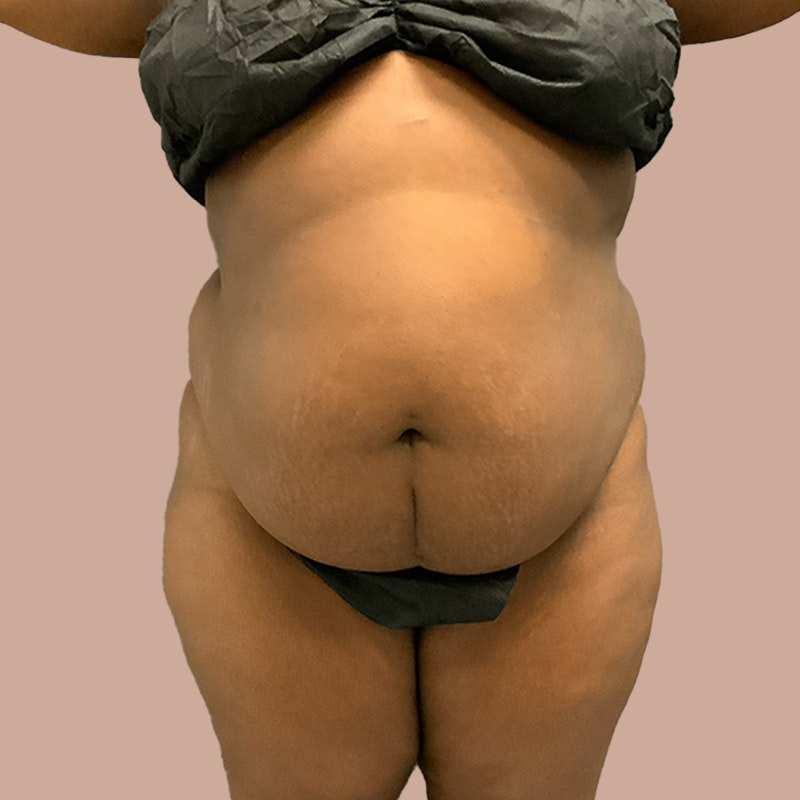before airsculpt