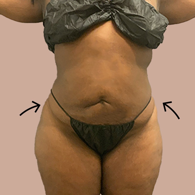 after airsculpt