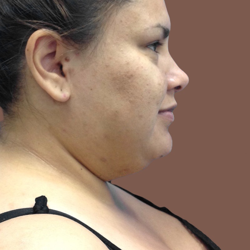 before chin airsculpt and weight loss