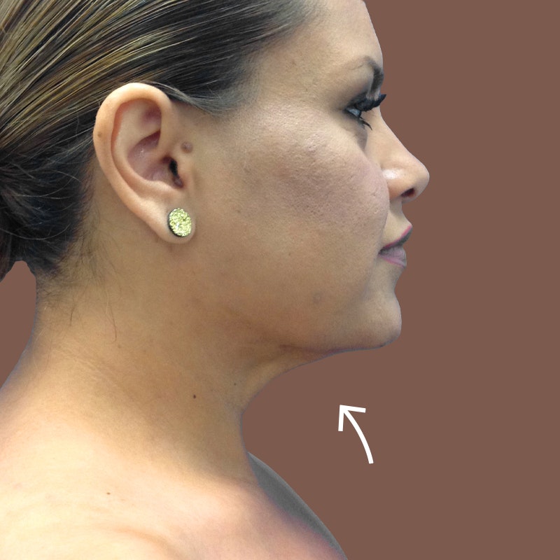 after chin airsculpt and weight loss