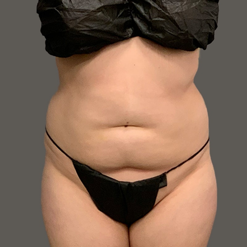 before stomach airsculpt and weight loss