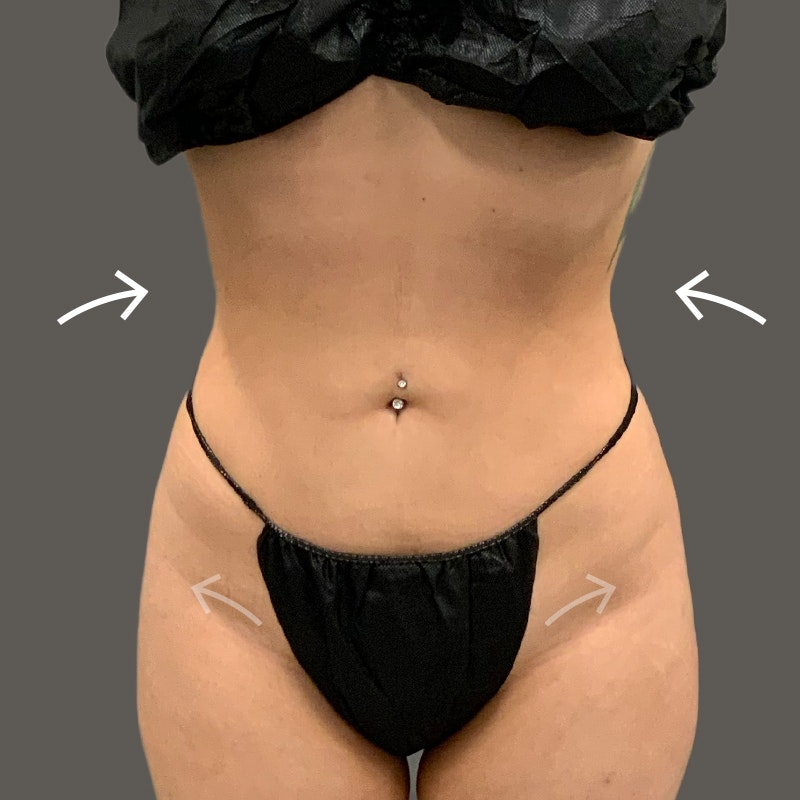 after stomach airsculpt and weight loss