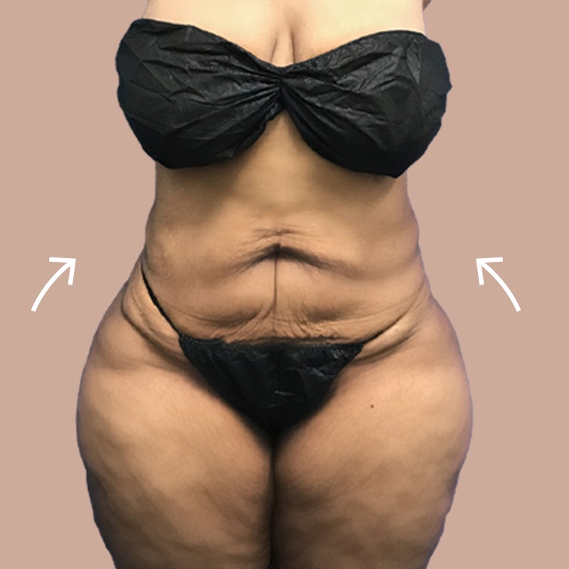 after airsculpt and weight loss