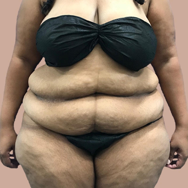 before airsculpt and weight loss