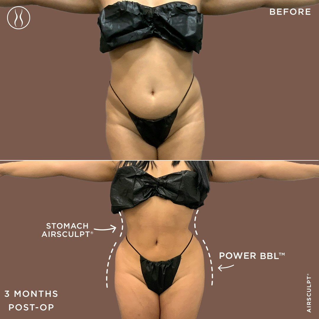 front view BBL before and after
