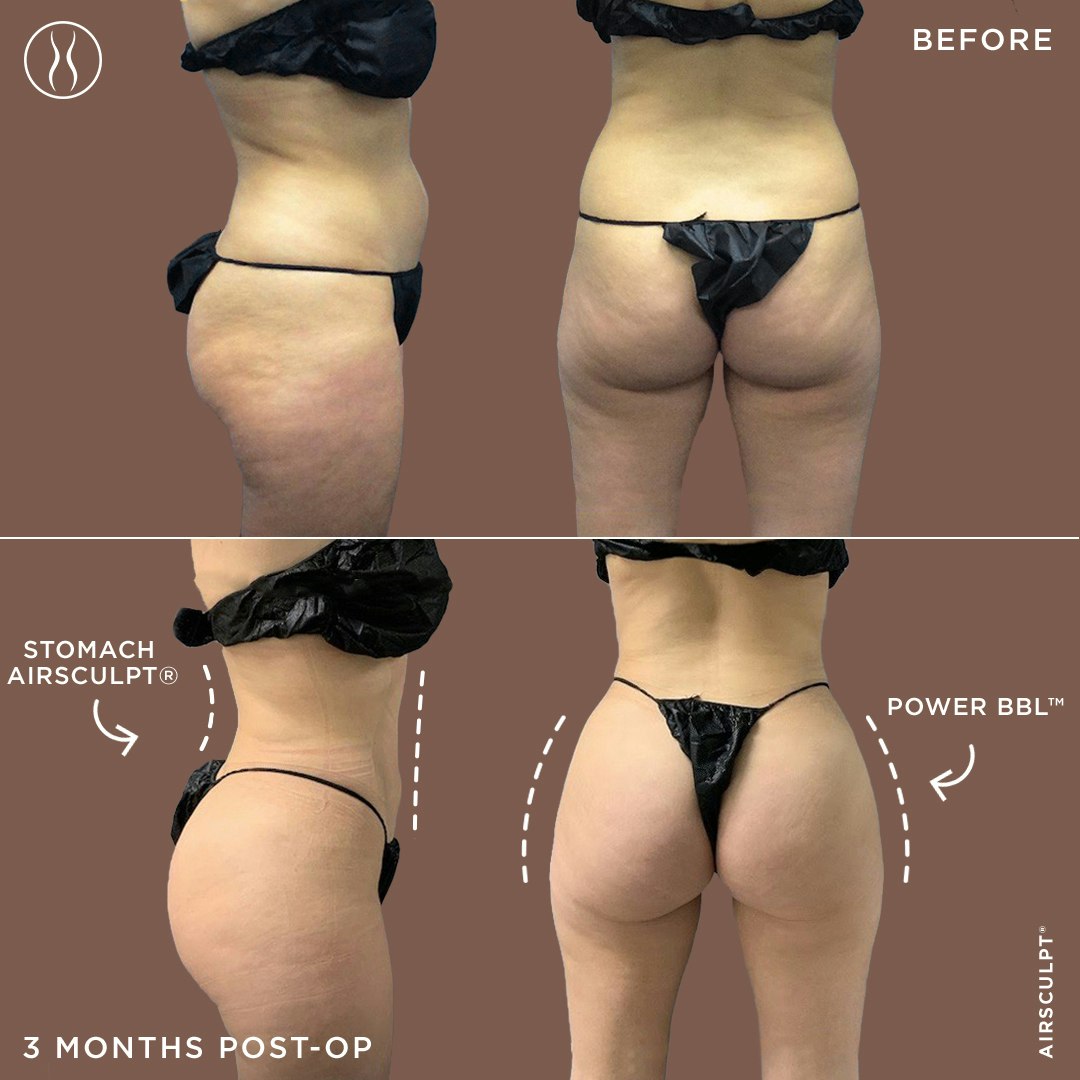double shot of front and side view BBL before and after