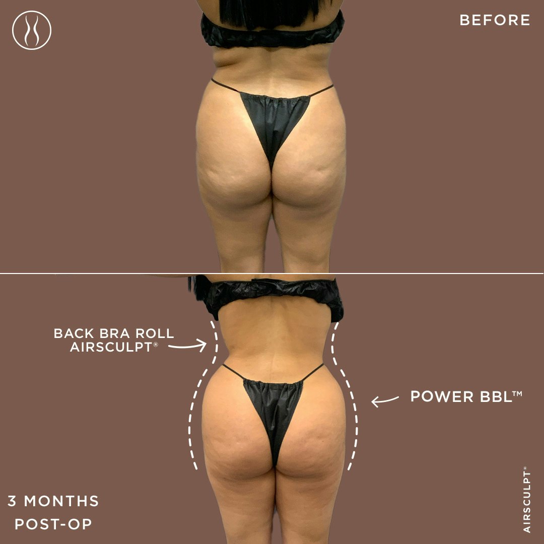 BBL Before and After photo