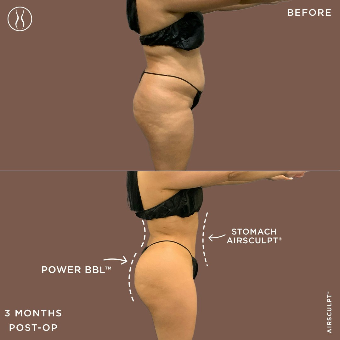 BBL and stomach lipo before and after
