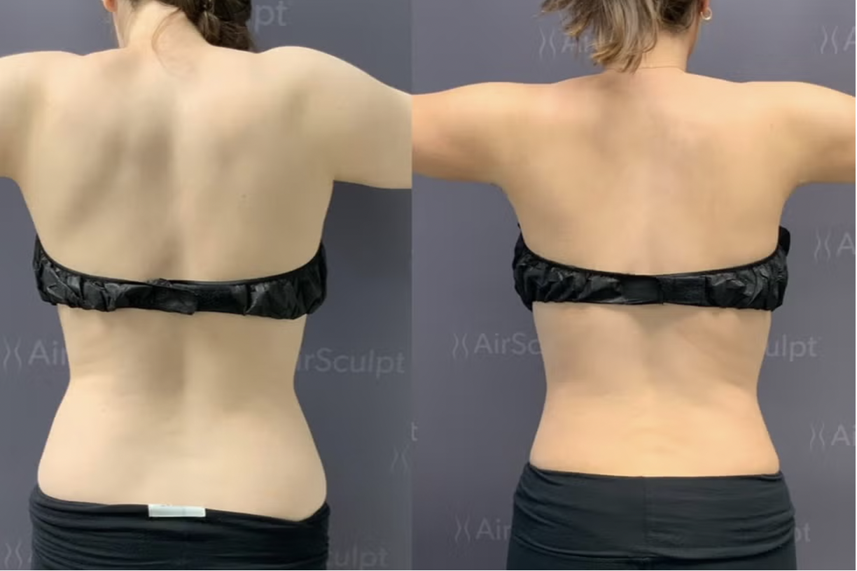 before and after photos of patient's back and waist