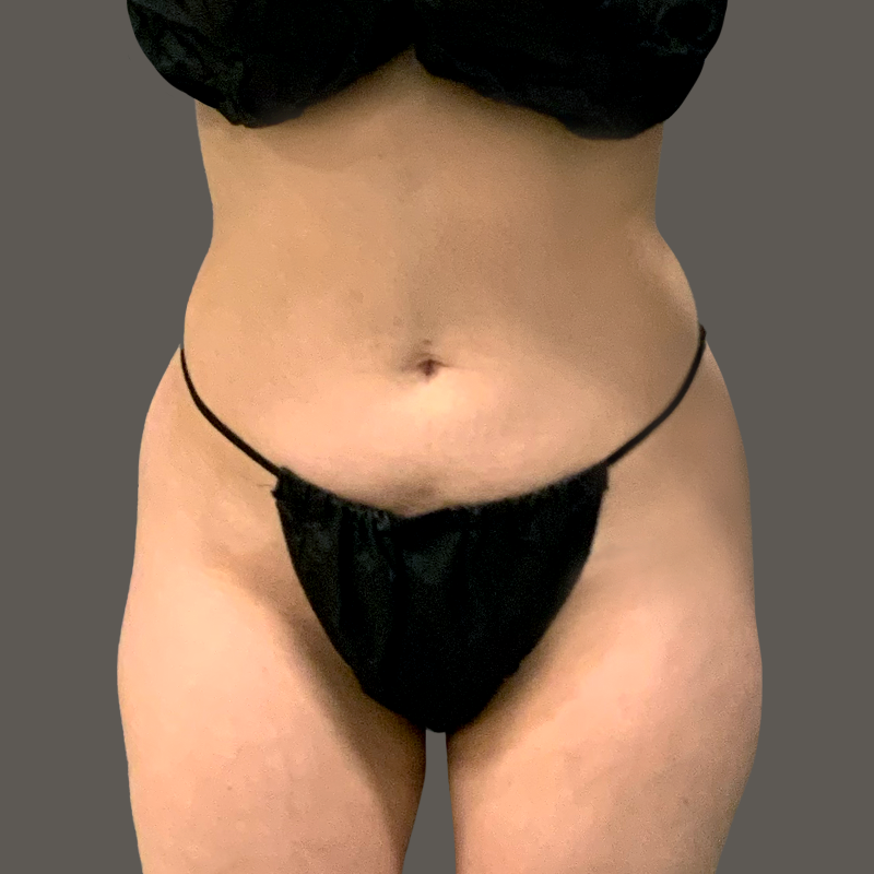 Ariana Before Airsculpt