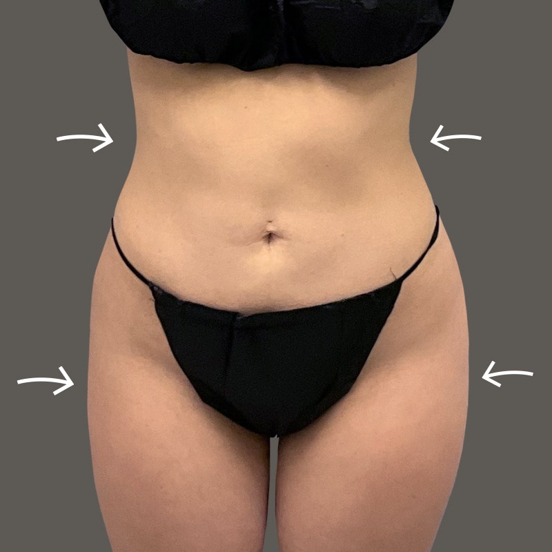 Ariana after airsculpt
