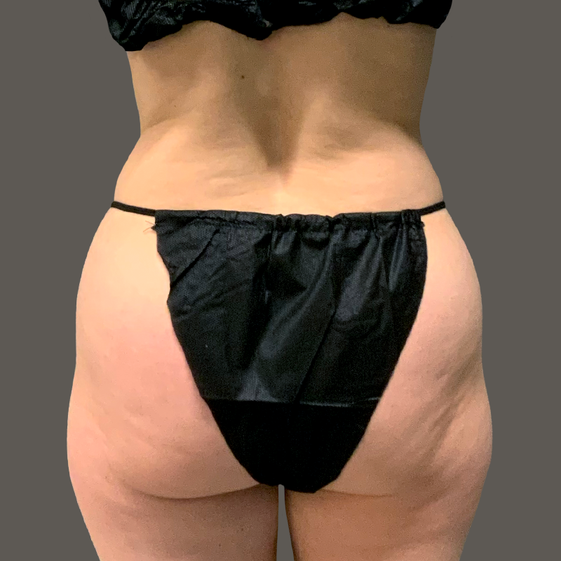 Ariana Before Airsculpt